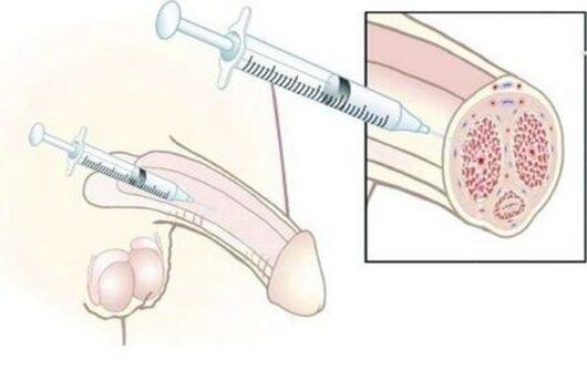 Injection of injections with hyaluronic acid