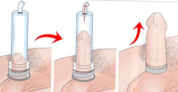 using a penis enlargement pump
