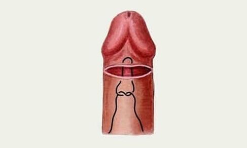 glans penis