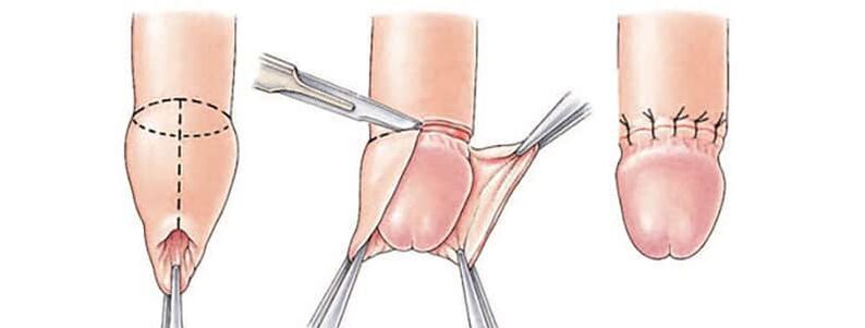 effect of circumcision on penis size