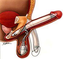 Implants for male penis enlargement